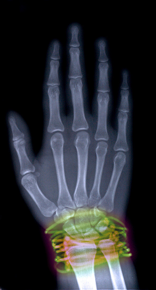 X-Ray of Girls Hand With Bracelets