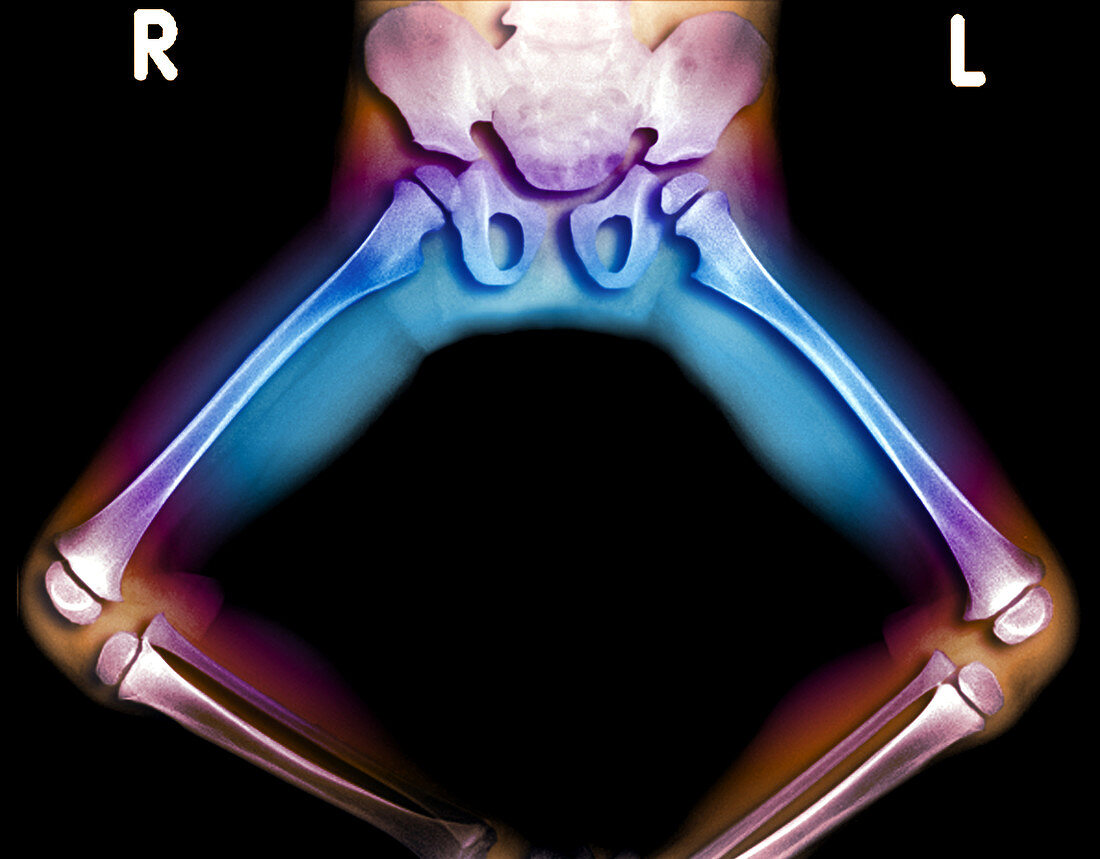 X-Ray of legs in frog position