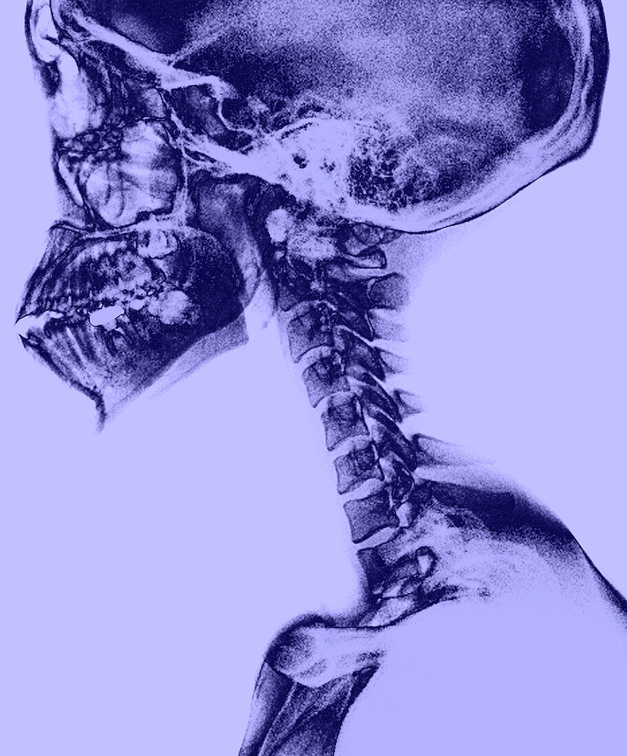 Human Skull and Spine