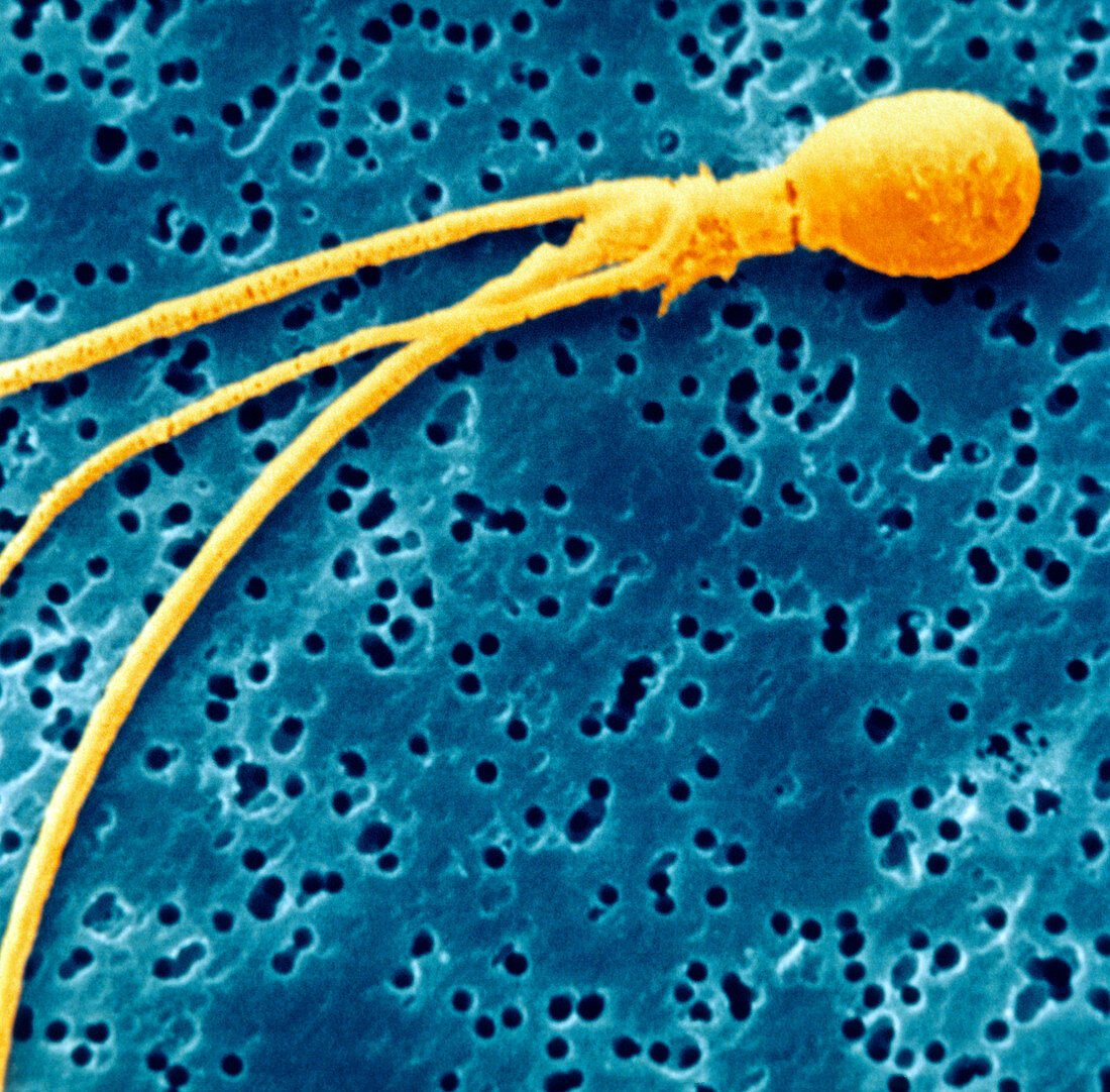 Coloured SEM of a deformed sperm (multi-tailed)