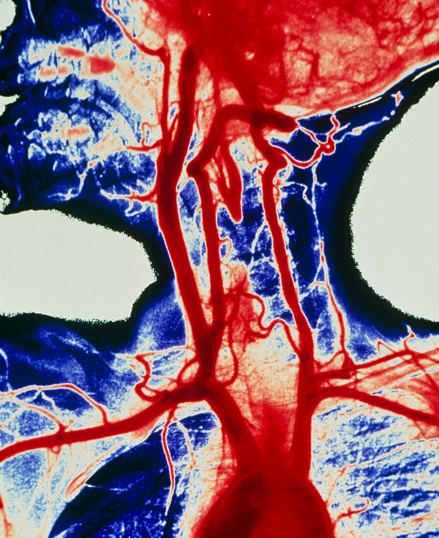 Coloured angiogram of carotid arteries