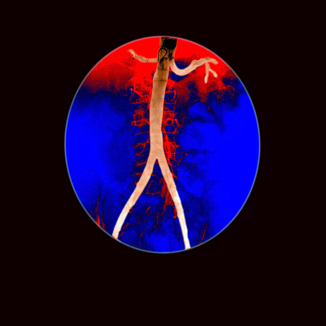 Angiogram of aorta and renal arteries