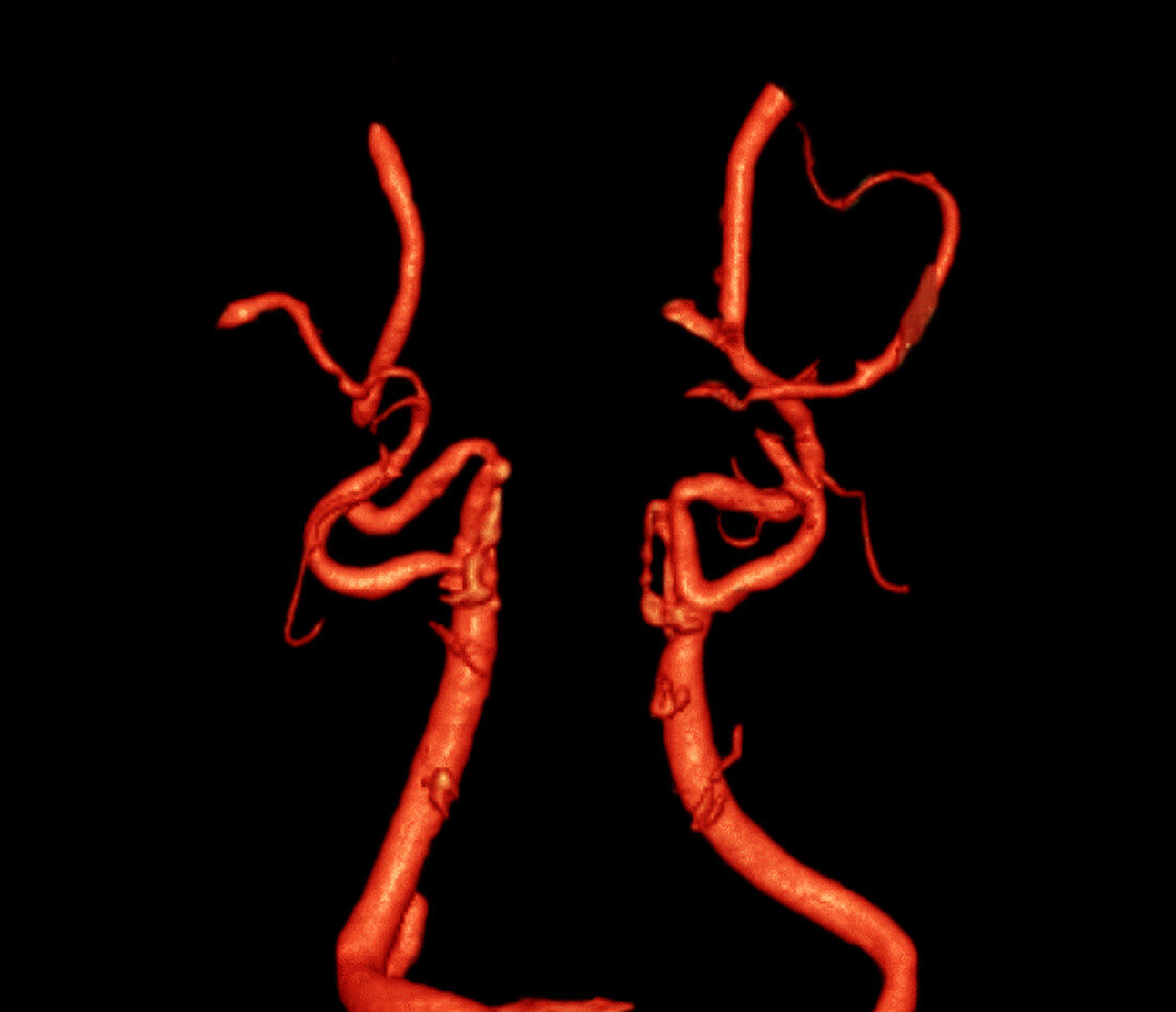 Carotid Arteries
