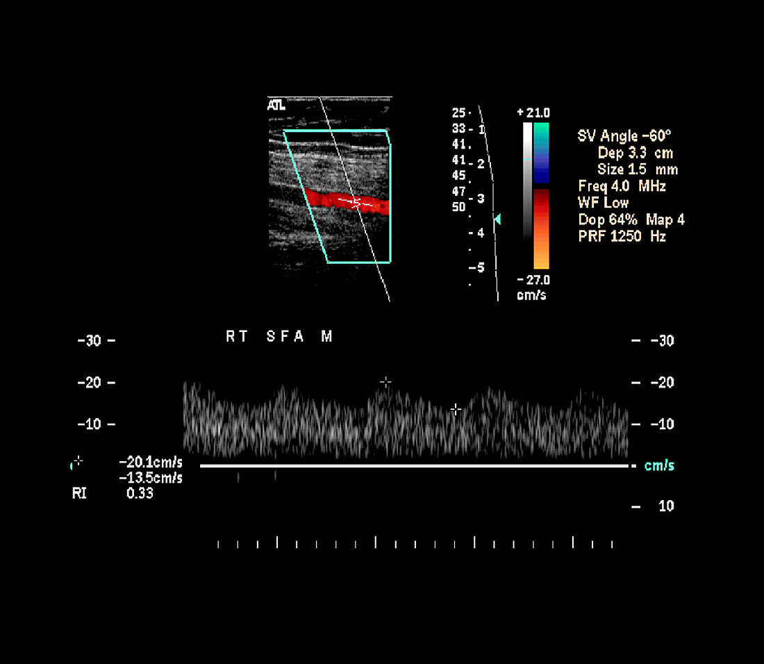 Duplex Vascular Ultrasound Exam