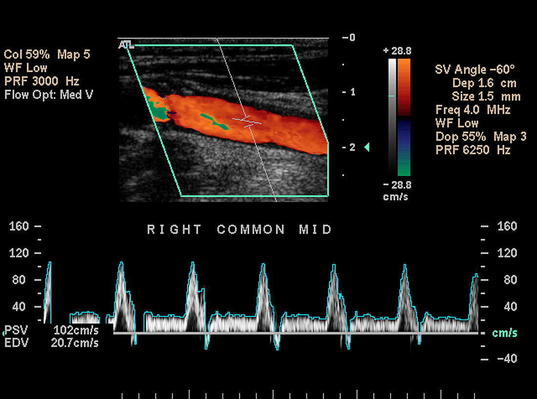 Carotid Duplex Ultrasound Exam