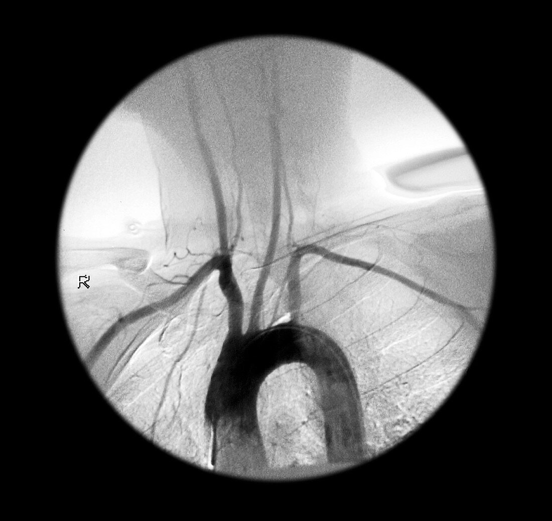 Aortic Arch Angiogram
