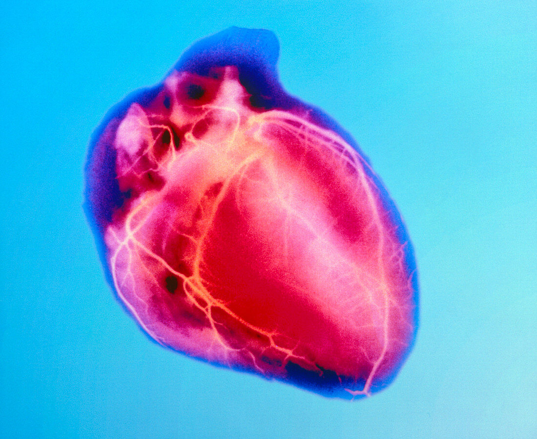 False-colour X-ray of a normal human heart