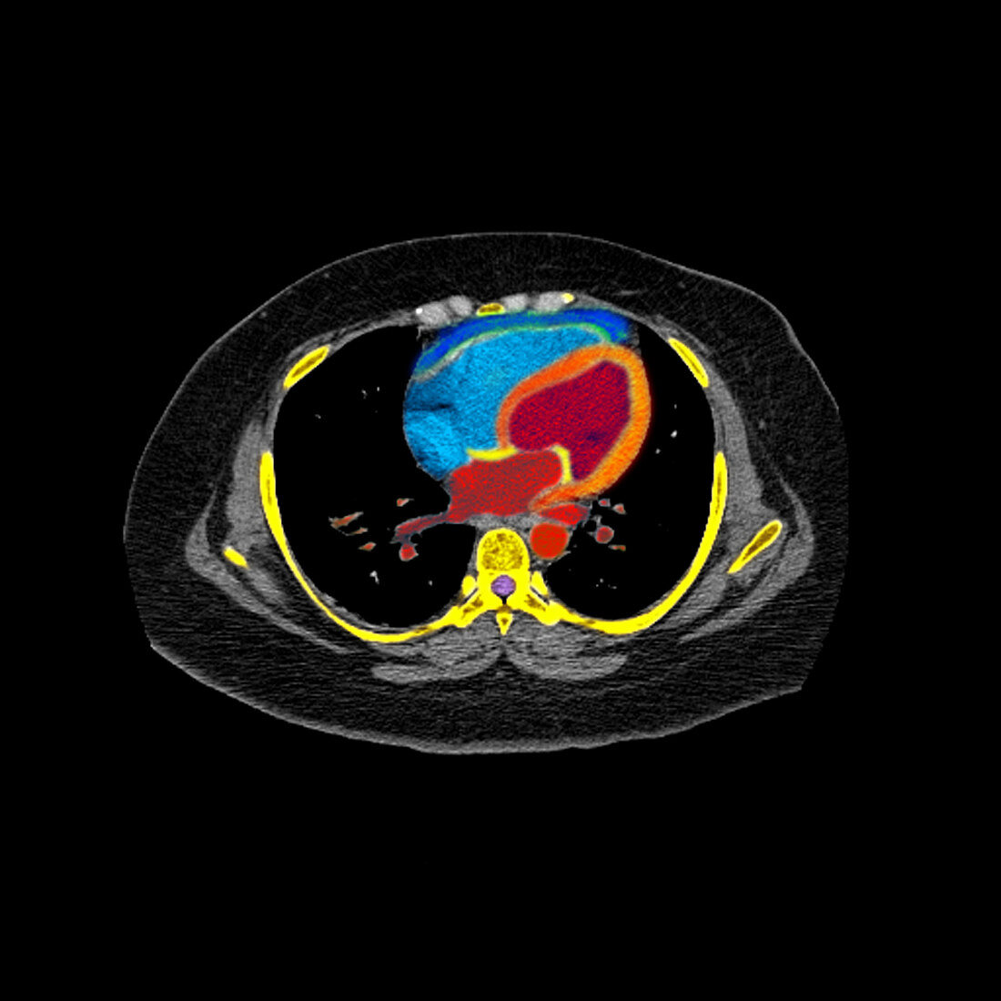 CT scan of chest through the heart