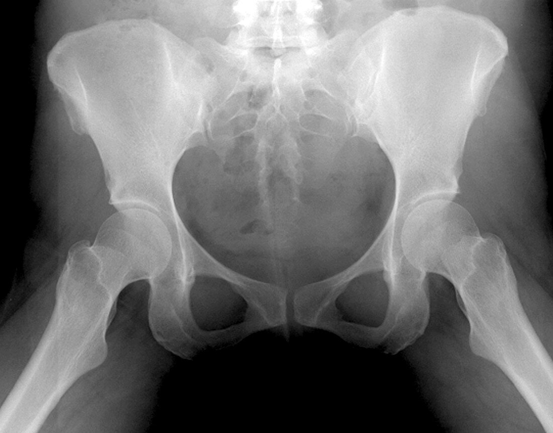 X-Ray of pelvis area