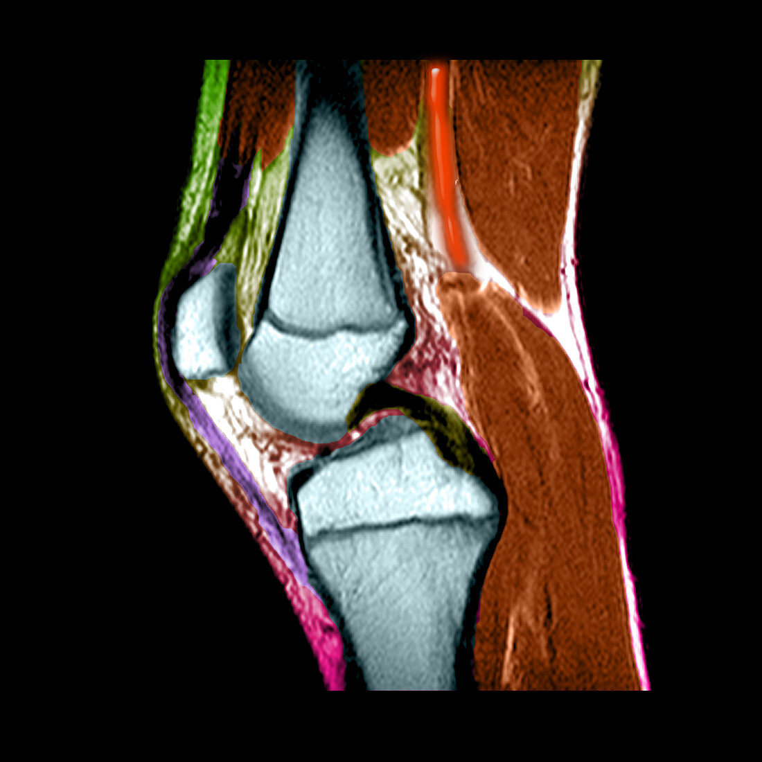 MRI of childs knee