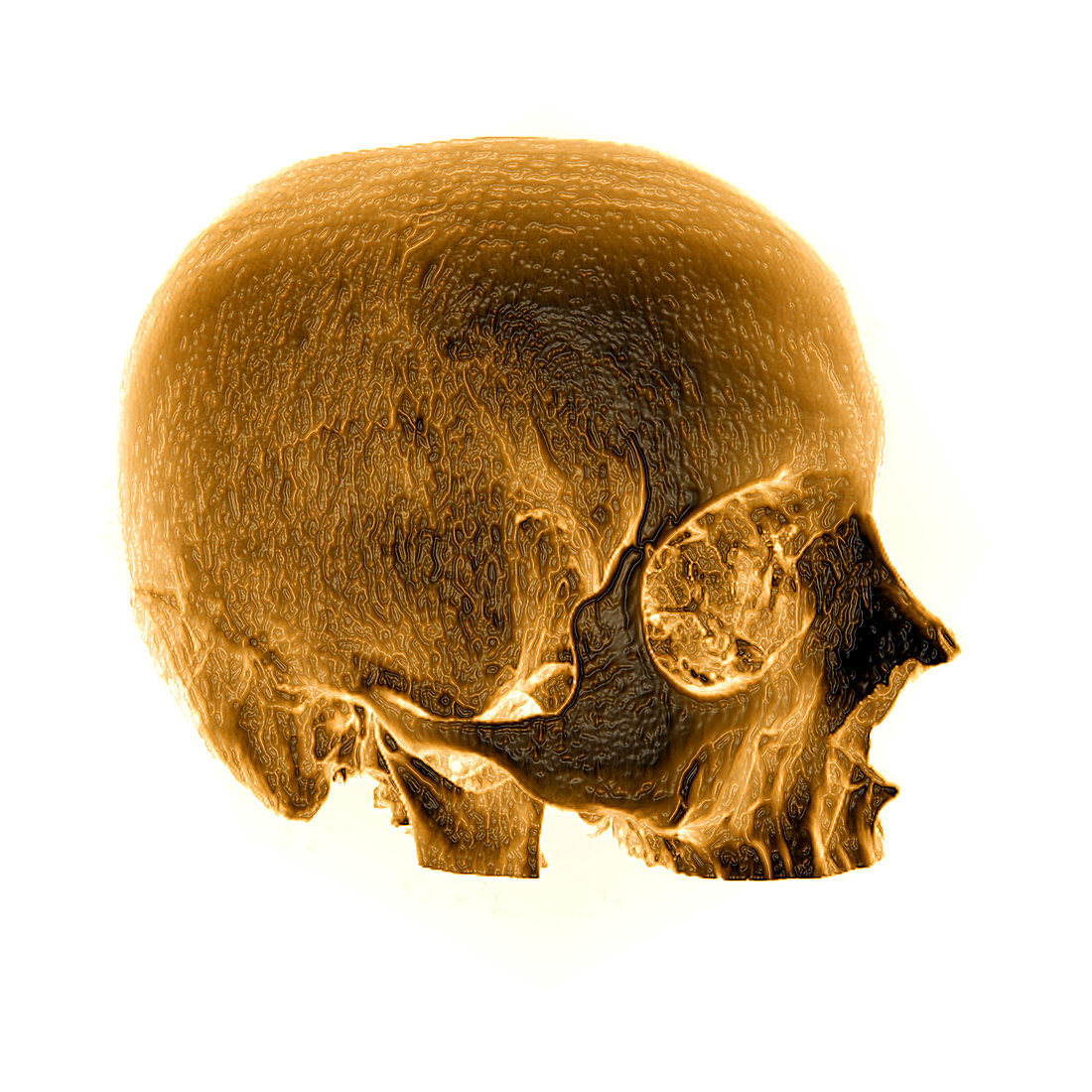 CT Reconstruction of Skull