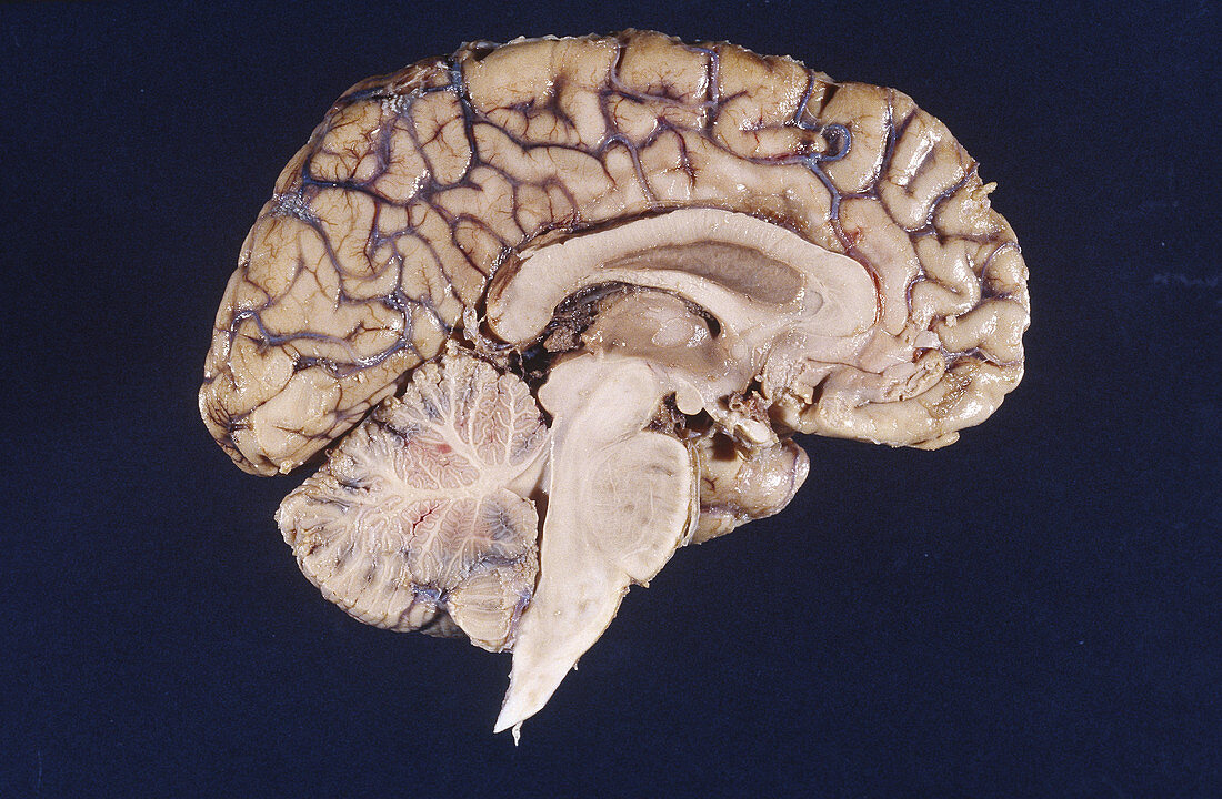 Midsagittal view of brain