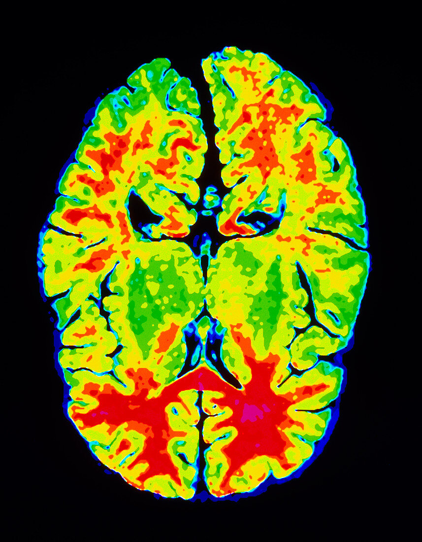 MRI horizontal image of a normal brain