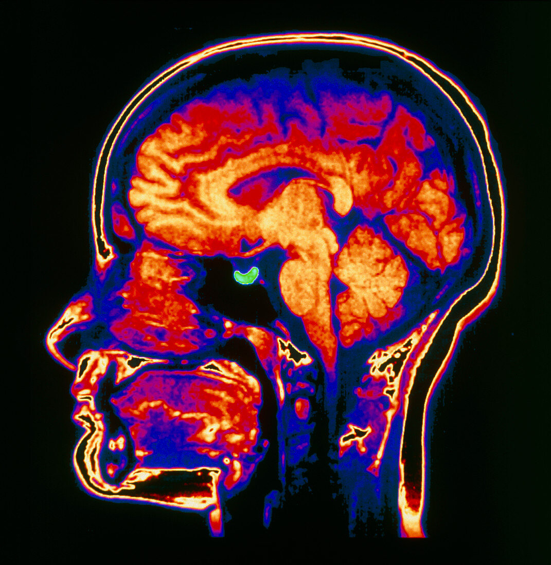 MRI scan of brain with pituitary gland highlighted
