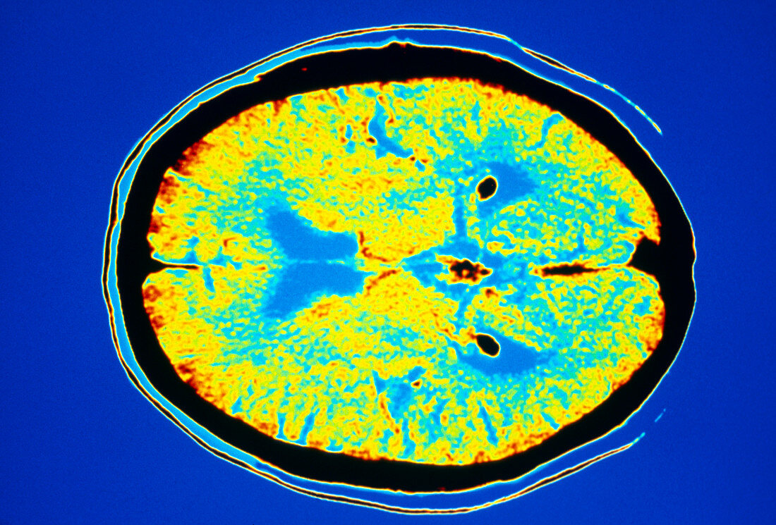 Coloured CT scan of section through healthy brain
