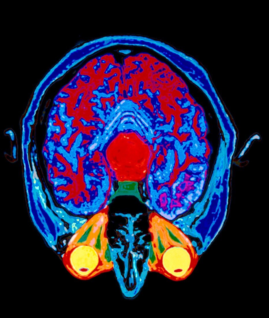Coloured MRI scan of axial section through head