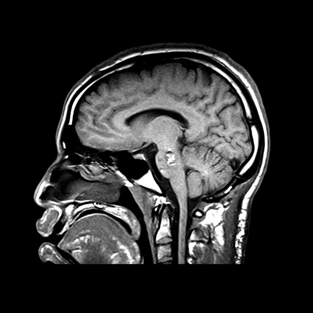 Sagital Cross Sectional MRI of the Brain
