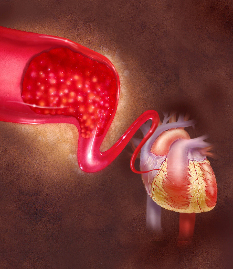 Illustration of a blood clot