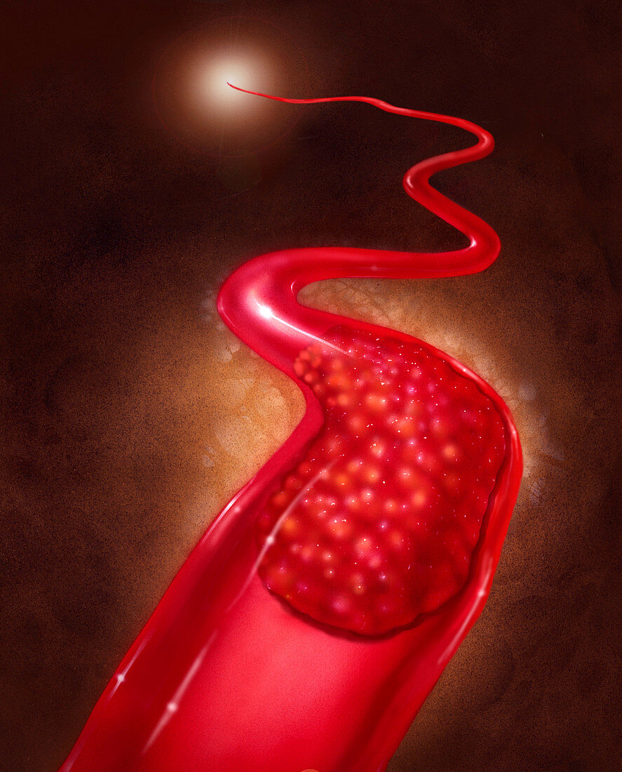 Illustration of a blood clot