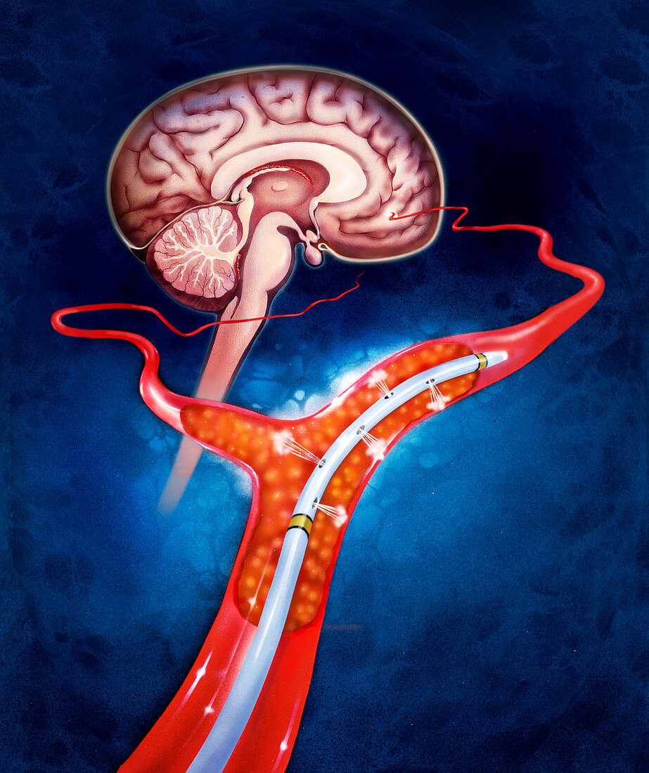 Illustration of brain blood clot therapy
