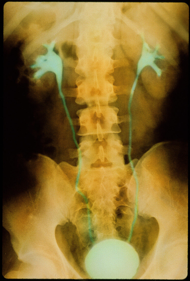 Colour X-ray of healthy kidneys,ureters,bladder