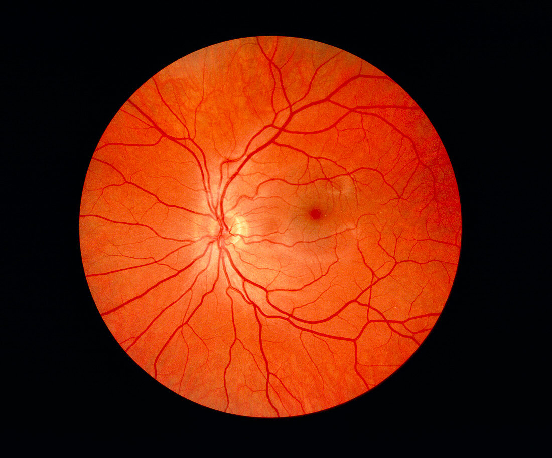 Ophthalmoscope image of a normal retina