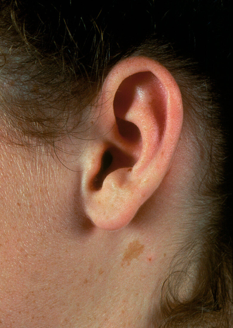 Genetic trait: free hanging earlobe