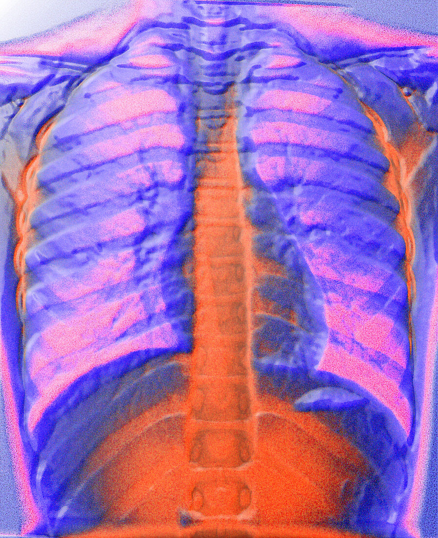 A normal chest X-ray
