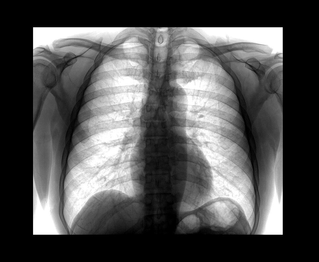 Normal Chest X-ray