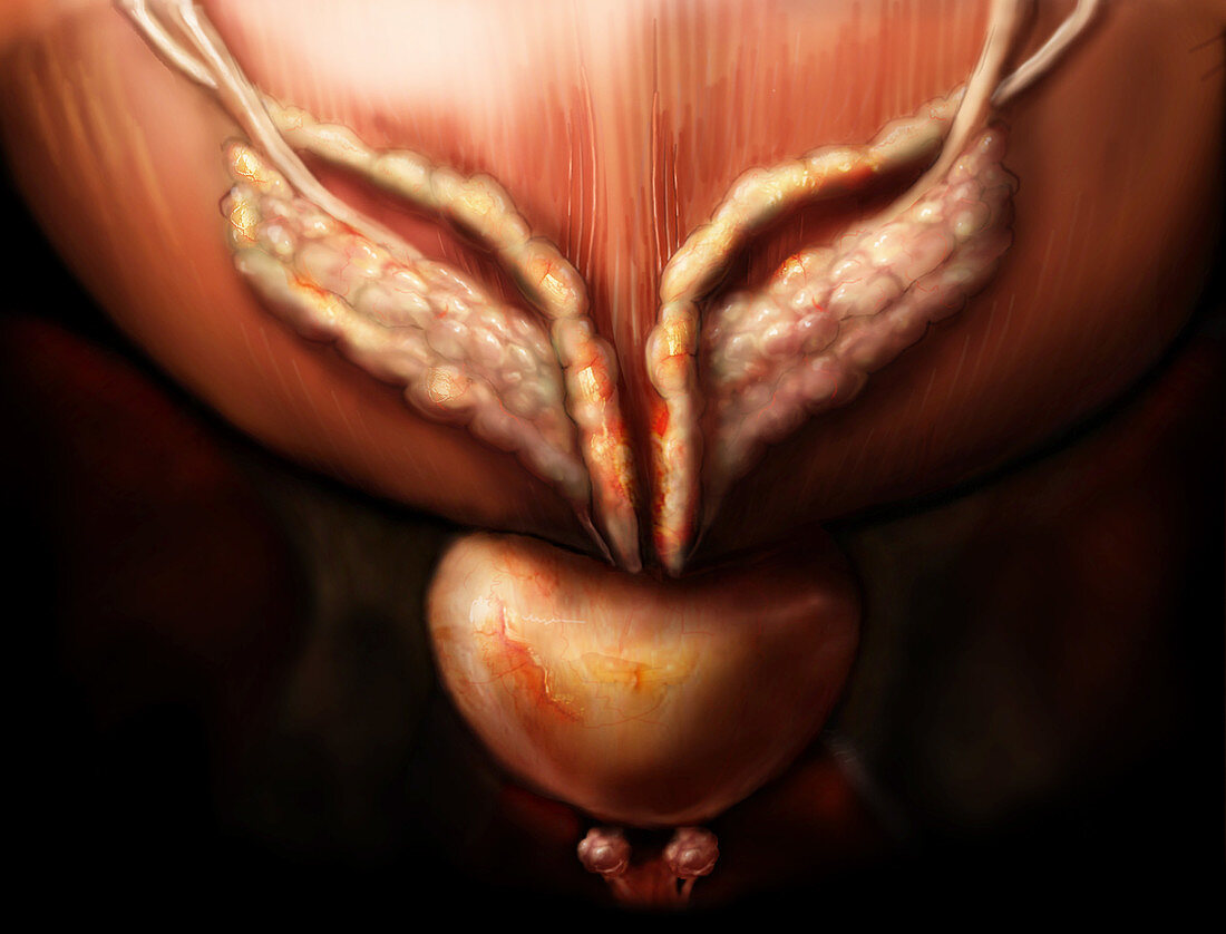 Prostate Gland and Seminal Vesicles