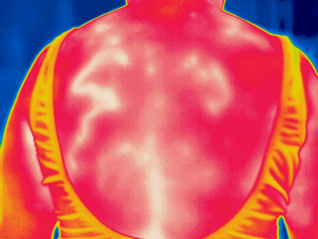 A thermogram of an elderly womans back