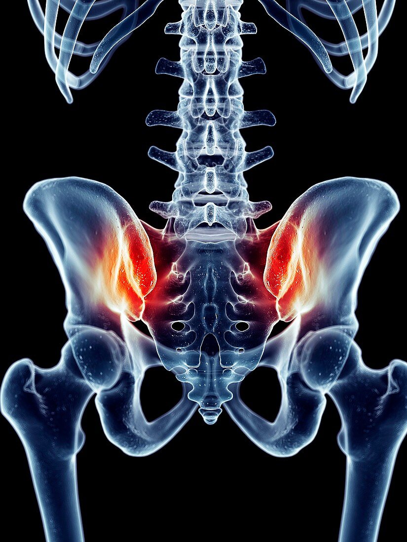 Human hip pain