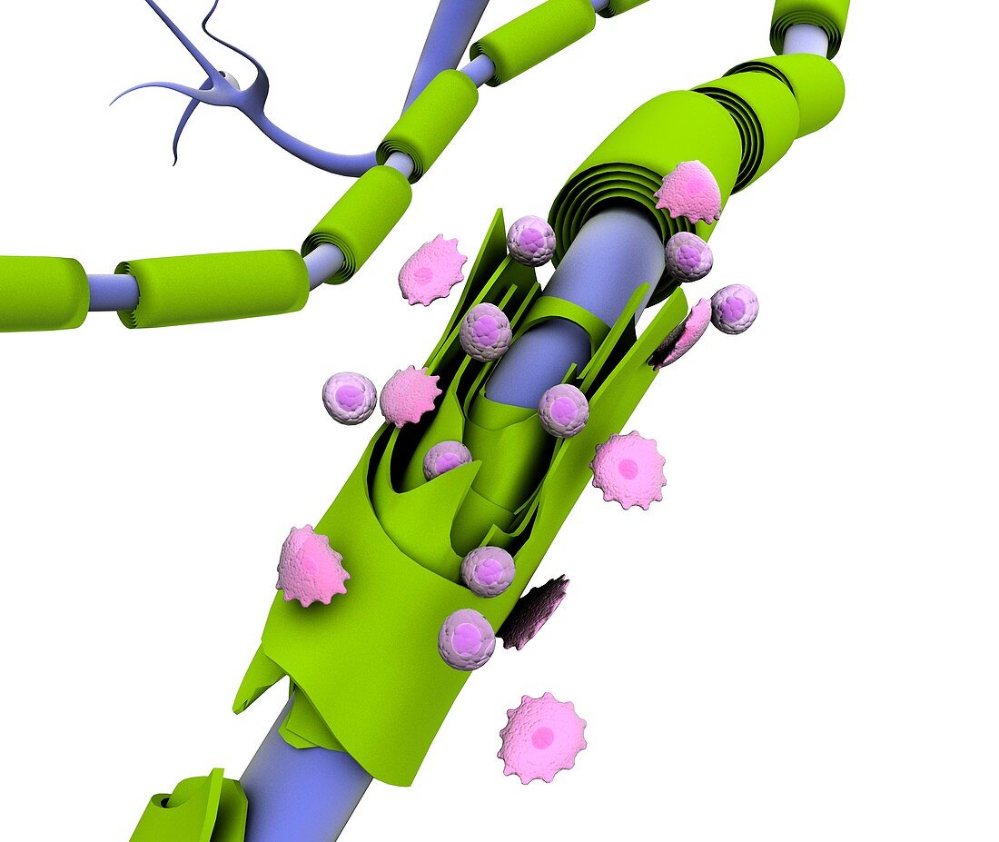 Nerve damage in multiple sclerosis