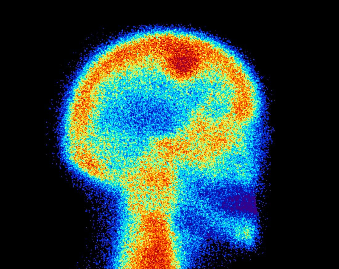 Bone scintigraphy of head showing tumour