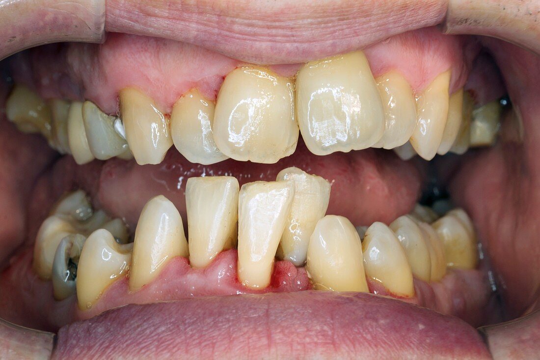 Teeth after cleaning