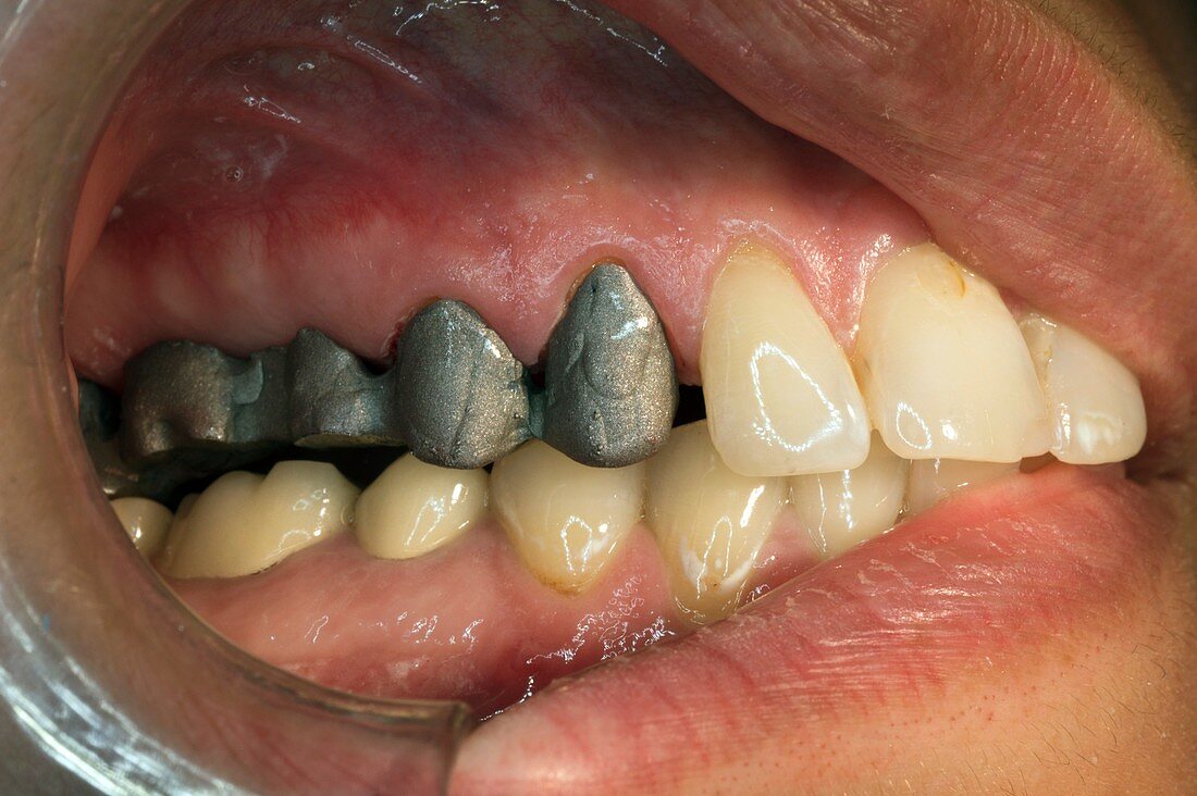 Dental bridge preparation