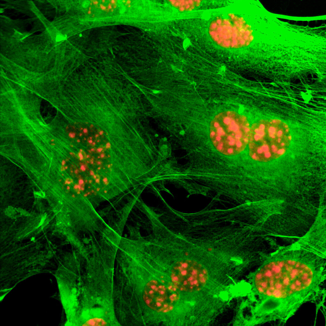 Emerging breast cancer cells