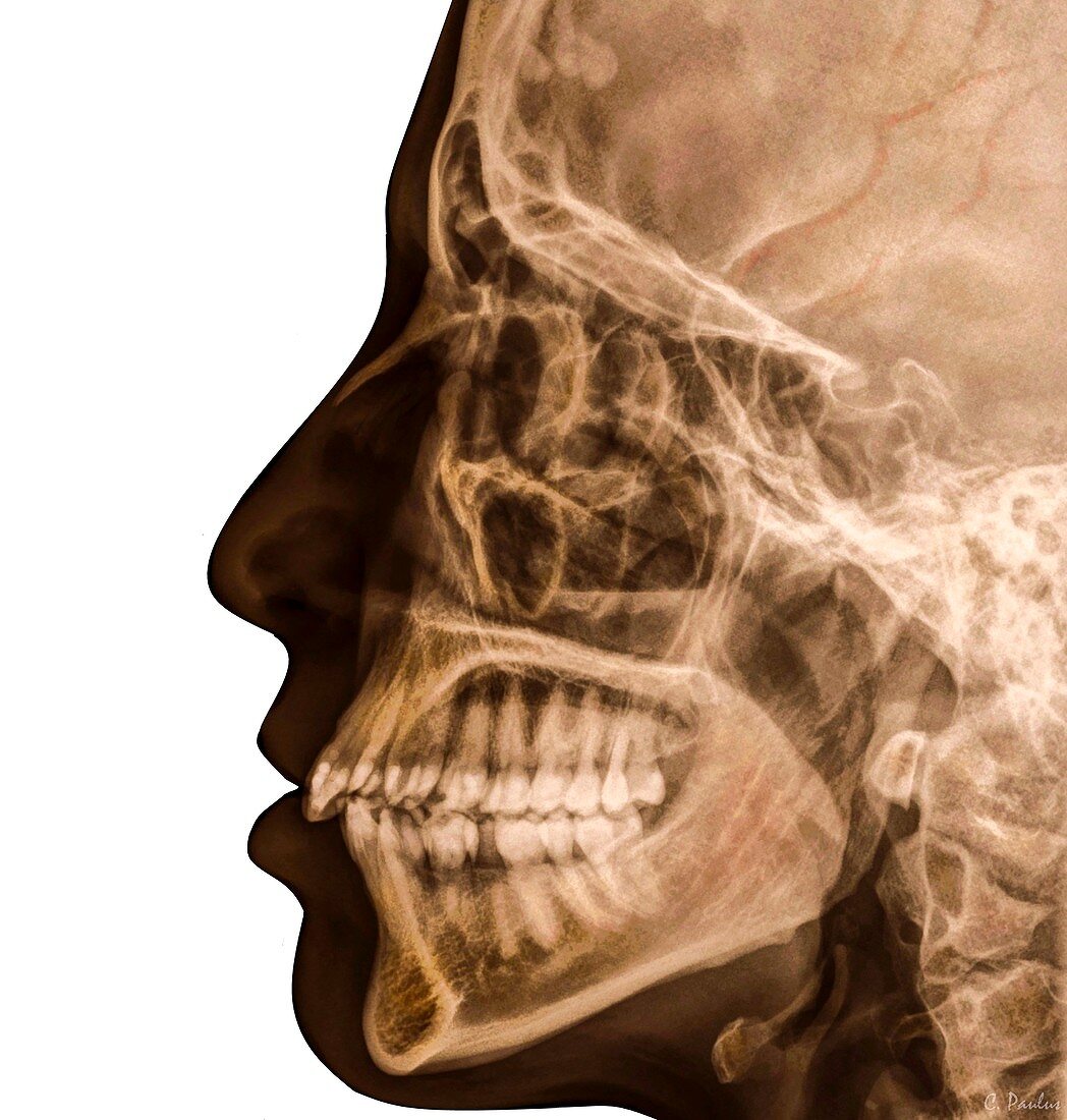 Head and skull, lateral X-ray
