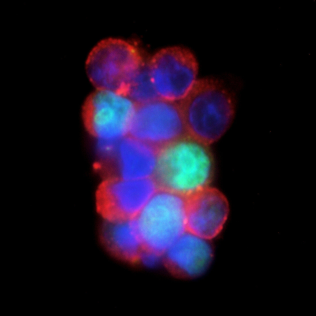 Circulating breast cancer cells