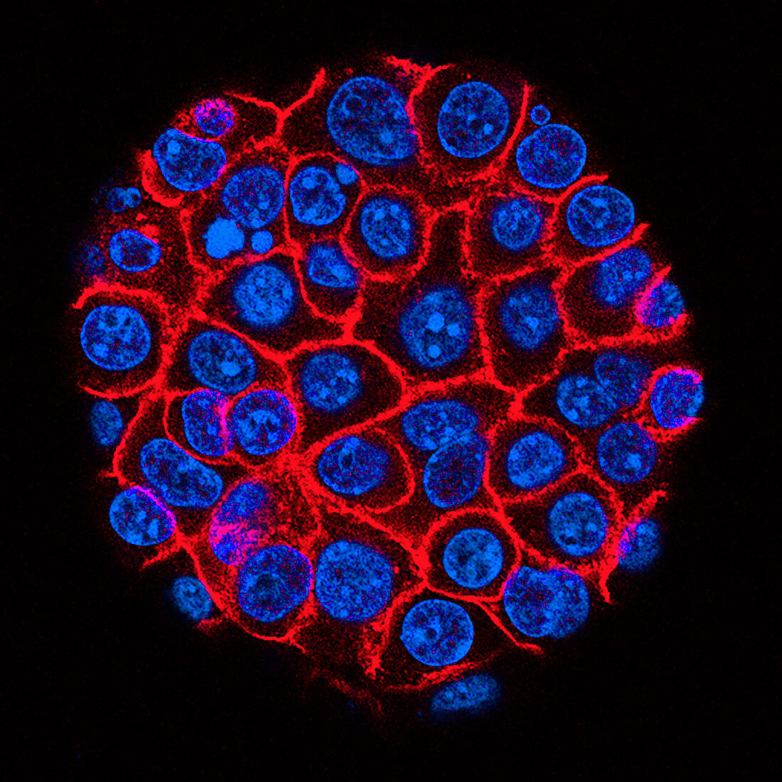 Pancreatic cancer cells, light micrograph