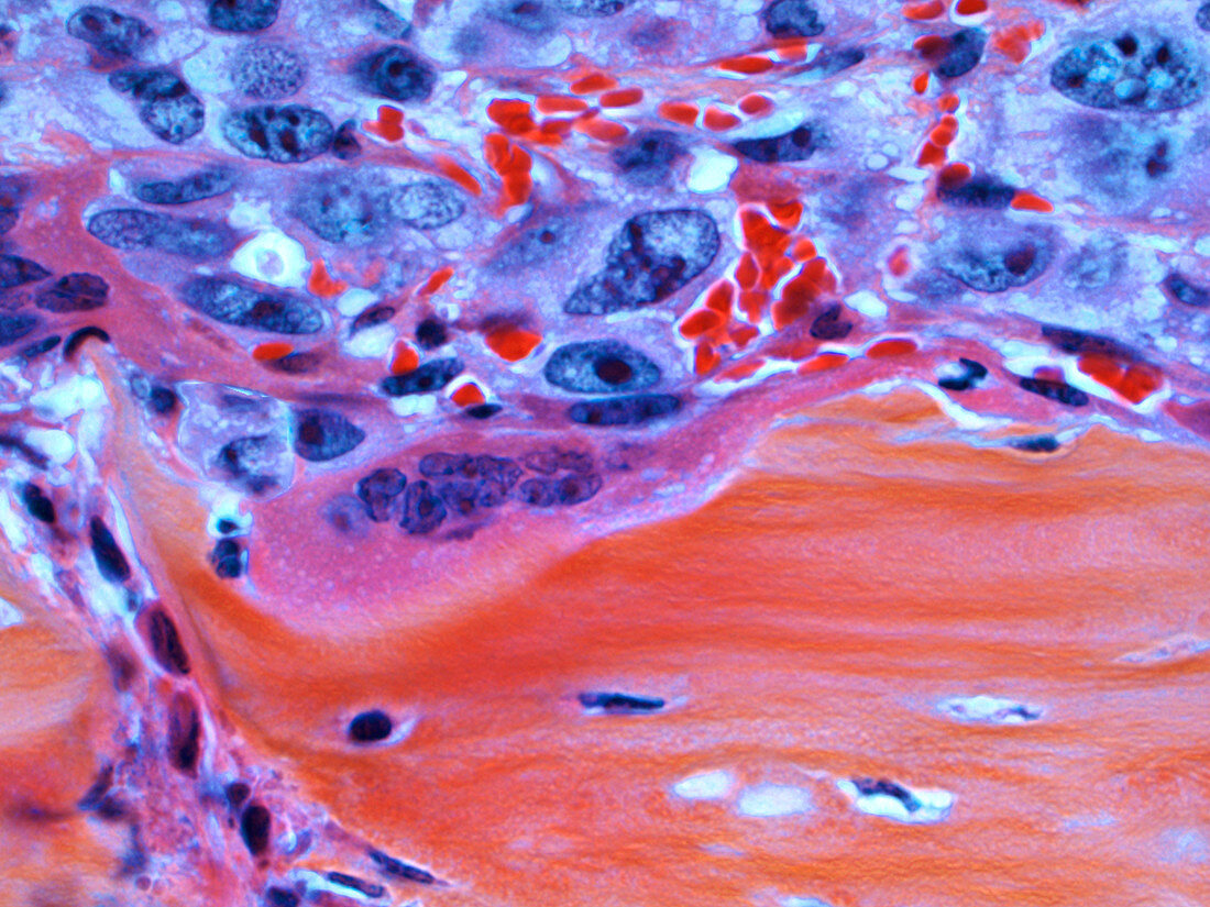 Metastatic bone cancer, light micrograph