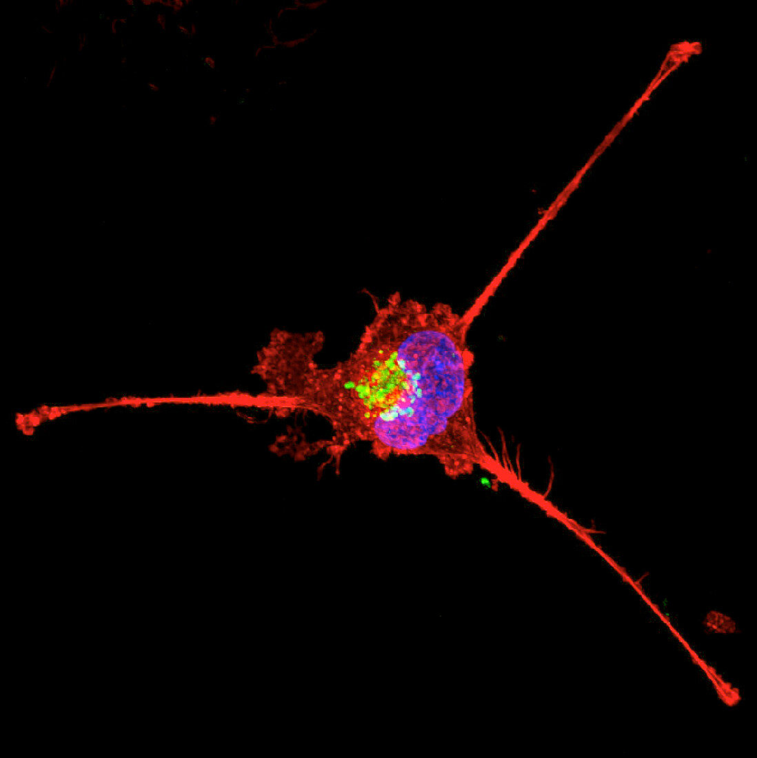 Triple-negative breast cancer cell