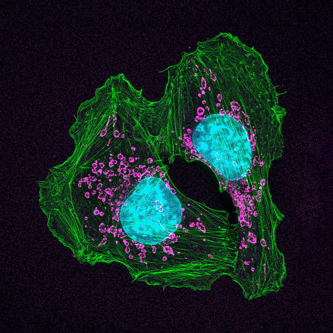 Skin cancer cells, light micrograph