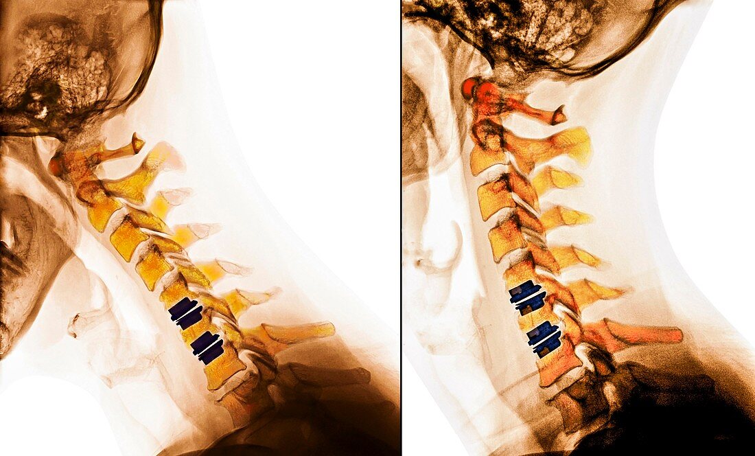 Artificial discs in the cervical spine, X-rays