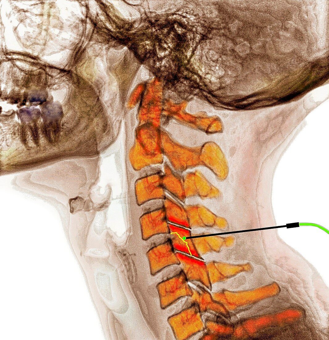 Spinal facet joint nerve ablation, X-ray