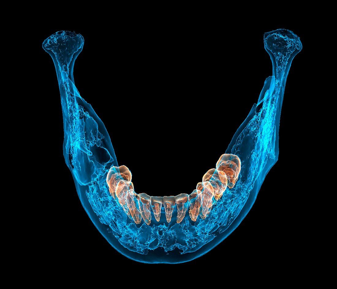 Bone tumour, 3D CT scan