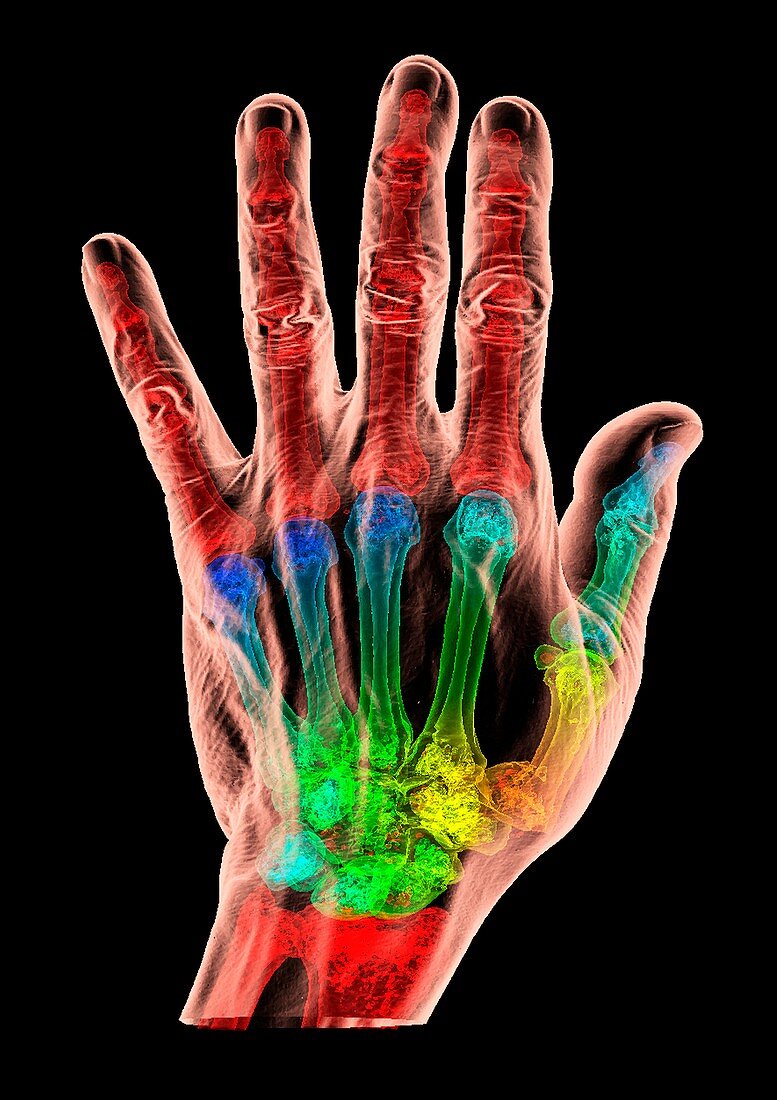 Thumb fracture, 3D CT scan