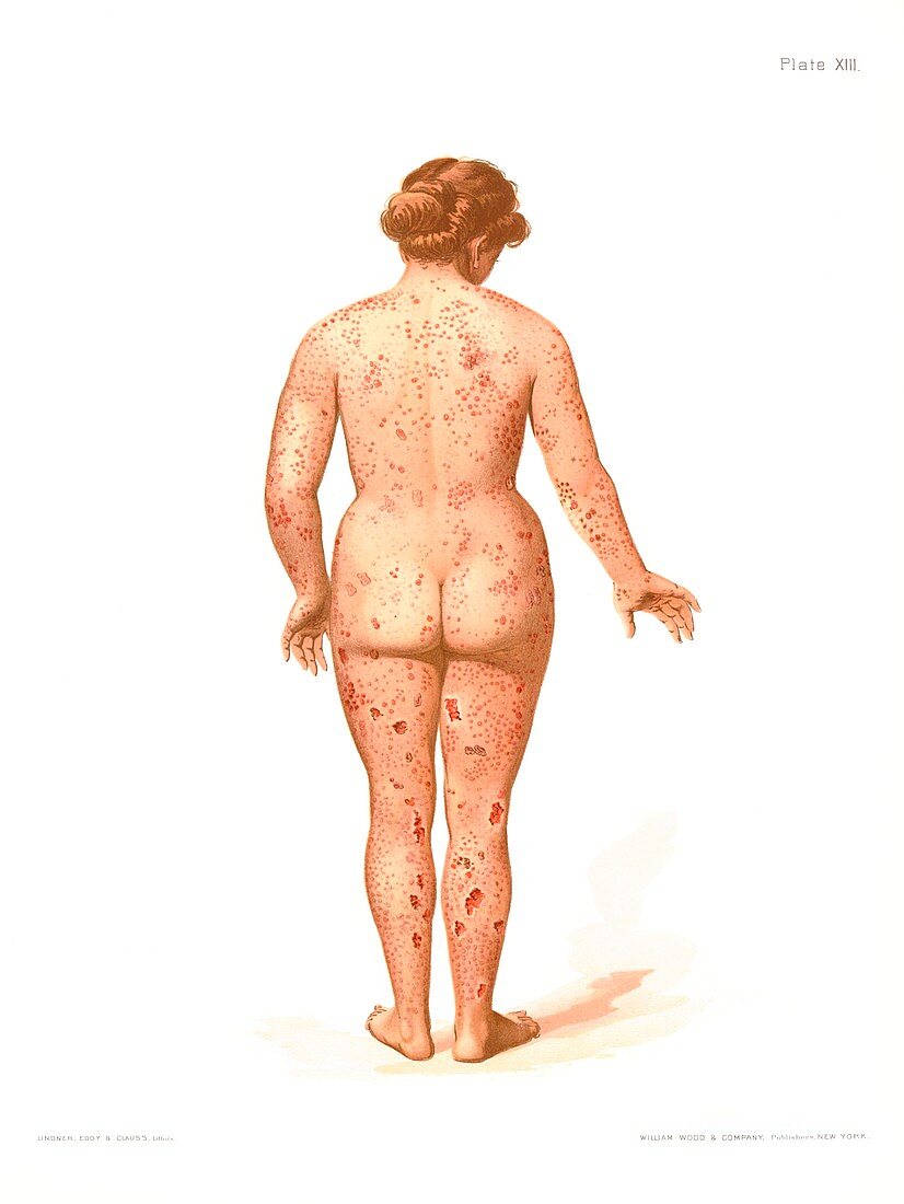 Secondary syphilis rash, illustration