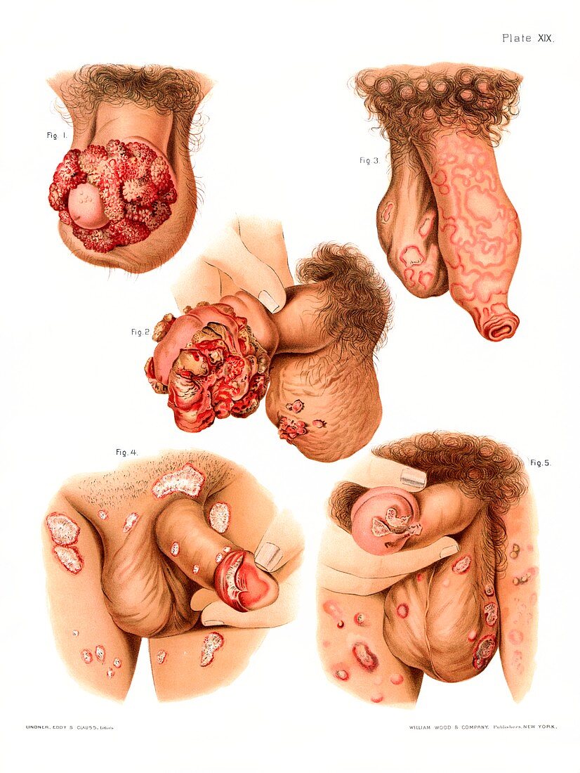 Penis disorders, historical illustration