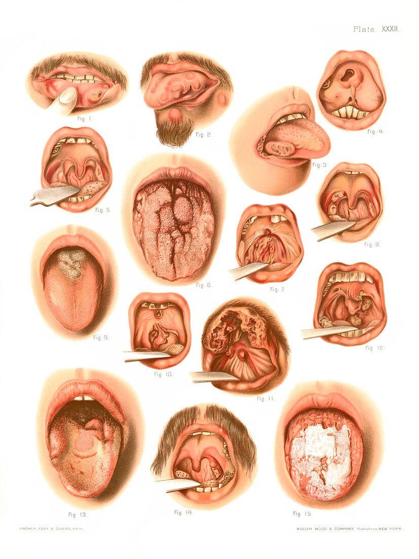 Tertiary syphilis lesions, illustration